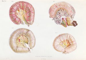 1849年にサンクトペテルブルクで出版されたニコライイワノビッチピロゴフ（1810-81）によるアナトミーパソロギークデュコレラモルバスのコレラに感染した腸の外表面