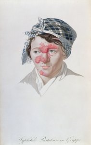 ジャンルイアリベール男爵（1768-1837）1838年の書物からの、梅毒のクラスター膿疱