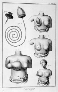 乳房手術、1751-1777 作： Unbekannt