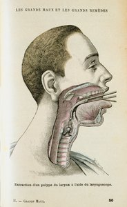 喉頭鏡を使用して喉からポリープを除去するのを助ける、c1890 作： Unbekannt