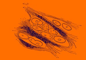 メラノイド癌の断面 作： Unbekannter Künstler