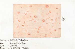病気、水疱瘡 皮膚病の水疱瘡の水彩画、1902年2月27日 作： Unbekannt