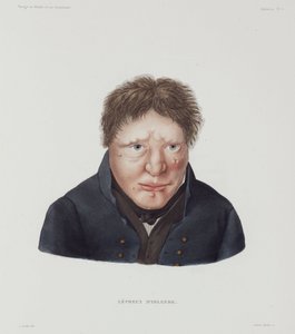 病気 ハンセン病 アイスランド 男性ハンセン病患者 19世紀初頭 作： Unbekannt