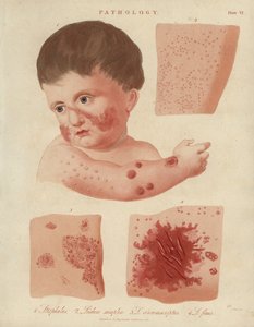 乳幼児の皮膚疾患