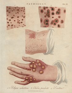 疥癬性ダニによる皮膚潰瘍、化膿性疥癬、疥癬 - ジョン・パスによるリトグラフ、ジョン・ウィルクス著 "Encyclopedia Londinensis "に掲載、J.Adlard版、ロンドン 作： Unbekannter Künstler