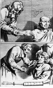 ヨハネス・スカルプテティ作「Armamentarium Surgery」アムステルダム1672年 出血と鼻腔シャワー