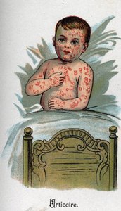 子供の病気のことじんましん。F.E.Bilzの "The New Natural Medicine "にて。 作： Unknown artist