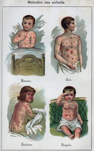 子供の病気。じんましん、はしか、疥癬、猩猩（しょうじょう）熱。F.E.Bilzの "The new natural medication "に掲載されています。 作： Unknown artist