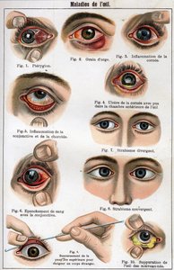 目の病気。"The new natural medicine" by F.E. Bilz. 作： Unknown artist