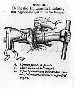 クライスリーブラダーを使った静脈注射。 by J. D. Mayor, "Surgery Infusoria", Kilonii 1667