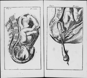鉗子を使った出産 ウィリアム・スメリー（1697-1763）の「An abridgemaent of practise of midwifery」より引用