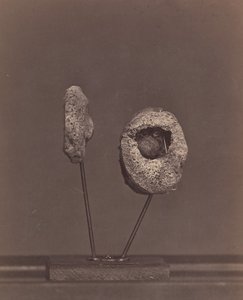 摘出された膝関節。右大腿骨内顆にマスケット銃の丸い玉［Gardin..., 1866-67. 作： William H. Bell
