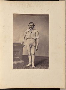 銃創に対する左大腿骨頭切除術の成功 作： William H. Bell