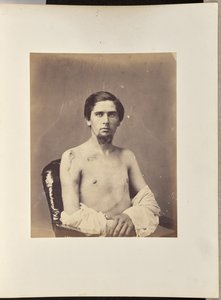 右上腕骨頭の切除成功 作： William H. Bell