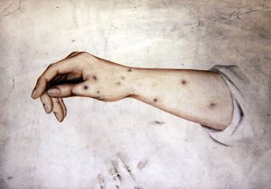 皮膚病の前腕部の習作 1850年頃 （紙に水彩画）