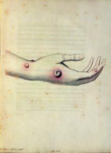 ピアース、1800年頃に刻まれたエドワードジェンナー（1749-1823年）による「ヴァリオラエワクシナエの原因と影響の調査」からのサラネルメスの腕にある牛痘の膿疱 作： William Skelton