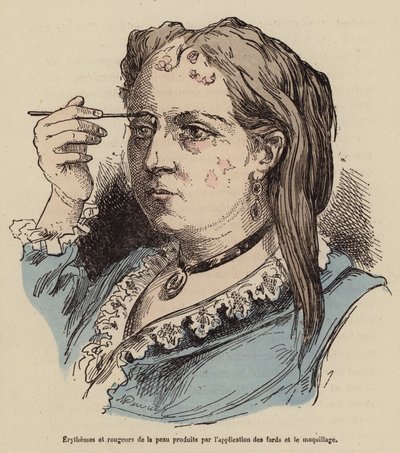 化粧による皮膚の発疹と赤みを持つ女性（カラー彫刻） 作： (after) French School