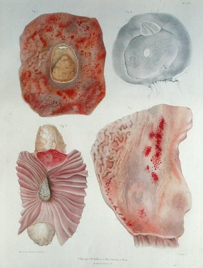コレラに感染した臓器（パリで出版されたヘルマン・ルベール（1813-78）の「Traite d