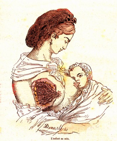おっぱいの中の子供（J.レンゲードの普通の生活と健康） - 授乳。1881年 A・デマール作 作： Alphonse Demarle