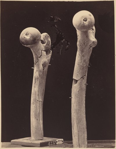 大腿骨銃創の標本、c.1867年（写真） 作： アメリカの写真家