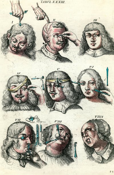 18世紀の外科手術。目と顔のトレパネーションと手術。ロレンツォ・ハイスターの「Institutionis chirurgicae」に掲載された版画 作： Anonymous Anonymous