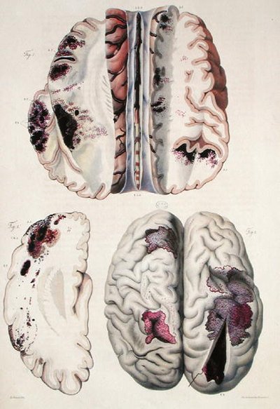 毛細血管性脳卒中、ジャン・クルヴェイリエ（1791-1874）1828-42年の「人間の病理解剖」より（彩色済み版画） 作： Antoine Chazal