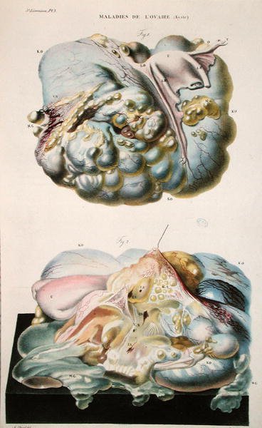 卵巣の病気、ジャン・クルヴェイユ（1791-1874）1828-42年の「人間の病理学的解剖」より（彩色彫刻） 作： Antoine Chazal