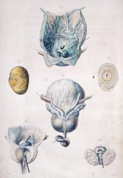 膀胱と前立腺の疾患、Jean Cruveilhier（1791-1874）の「Anatomie Pathologique du Corps Humain」より 1828-42年（彩色された彫刻）。 作： Antoine Chazal