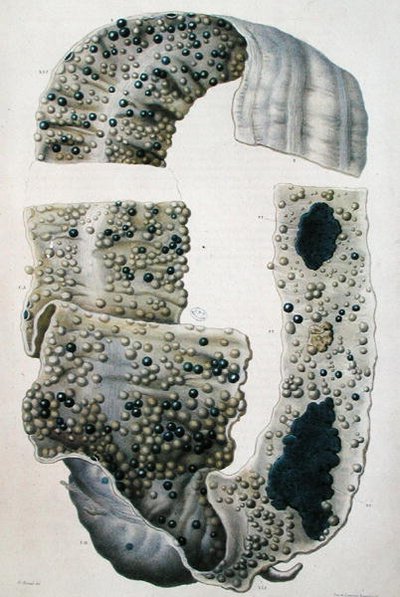 Jean Cruveilhier（1791-1874）1828-42年の「Anatomie Pathologique du Corps Humain」より腸の病気（彩色彫刻） 作： Antoine Chazal