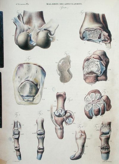 ジャン・クルヴェイリエ（1791-1874）1828-42年『人間の病理解剖』より関節の病気（彩色された彫刻版） 作： Antoine Chazal