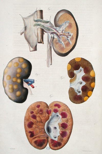 Jean Cruveilhier（1791-1874）1828-42年の「Anatomie Pathologique du Corps Humain」より、腎臓の疾患（彩色彫刻） 作： Antoine Chazal