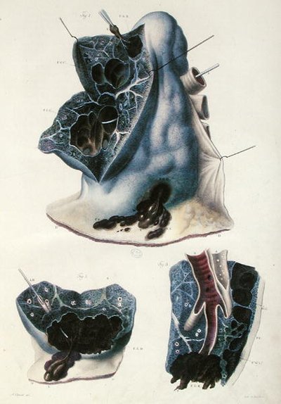 Jean Cruveilhier (1791-1874) 1828-42年の「Anatomie Pathologique du Corps Humain」より肺の疾患（彩色彫刻） 作： Antoine Chazal