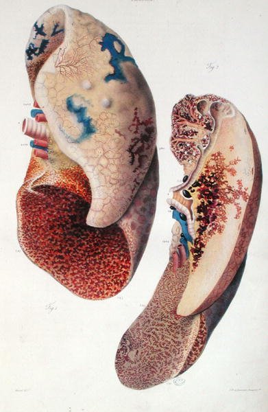 Jean Cruveilhier（1791-1874）の「Anatomie Pathologique du Corps Humain」から肺炎（1828-42年、彩色済み彫刻）。 作： Antoine Chazal