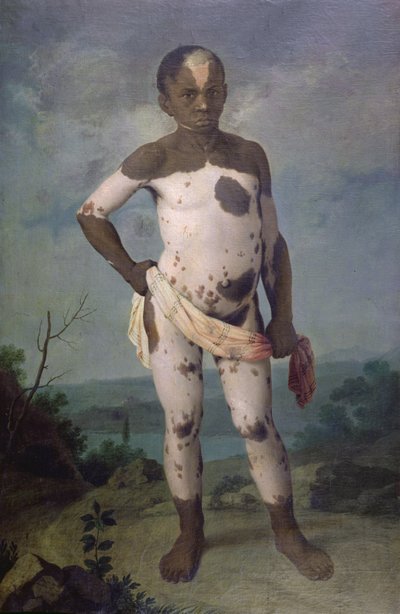 白斑の子供、1786年 作： Brazilian School