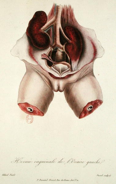 左卵巣の鼠径ヘルニア、Charles-Michel Billard著「Traite des Maladies des Enfans Nouveaux-Nes et a la Mamelle」より、Stasselが彫刻したもの。 作： Charles Michel (after) Billard