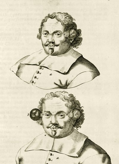 カッピングの例、実践的な演習からフレデリックデッカーズによる治癒法まで、1694年 作： Dutch School