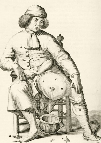 膿瘍からの液体の排出、Frederic Dekkersによる実践的な練習から治癒方法、1694年 作： Dutch School