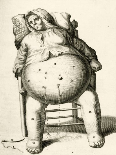膿瘍からの液体の排出、Frederic Dekkersによる実践的な練習から治療法まで、1694年 作： Dutch School