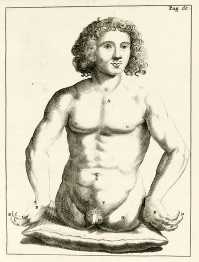 先天性先天性欠損症の例、Frederic Dekkersによる実践的な演習から治療法まで、1694年 作： Dutch School