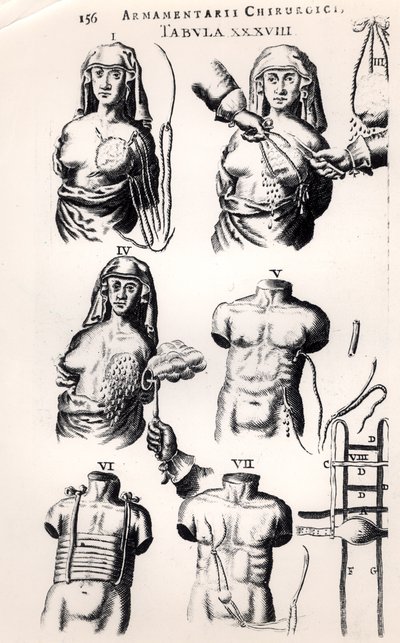 1672年にアムステルダムで出版されたJohannes Schultes（1595-1645）によるArmamentarii Chirurgiciによる乳がんの手術 作： Dutch School