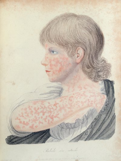 ドイツのはしか、ロバート・ウィラン（1757-1812）による本のイラスト、1808（カラー彫刻） 作： English School