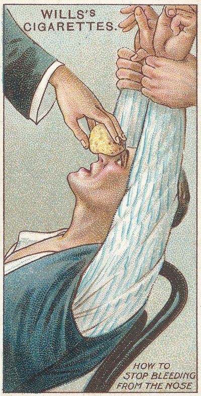鼻からの出血を止める方法、Wills Cigarettesカードの応急処置シリーズのno.31、1913年 作： English School