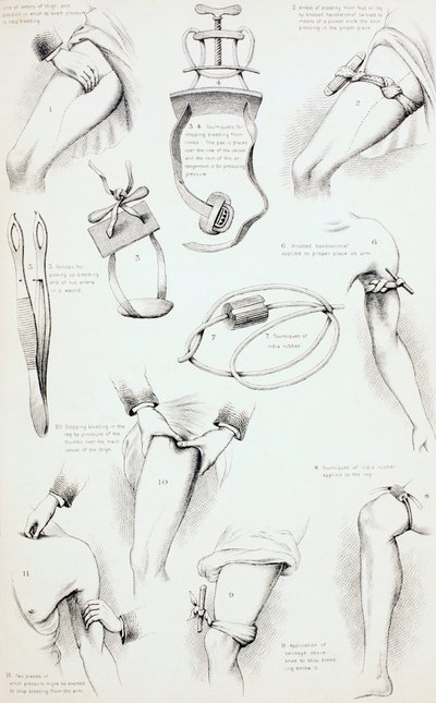 出血を止める方法、c.1890 作： English School