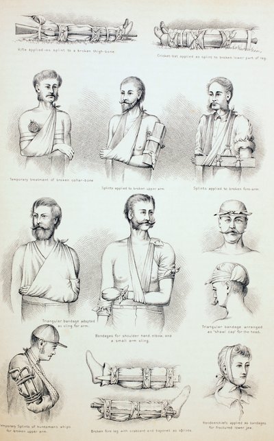 骨折の一時的な治療、1890年頃 作： English School