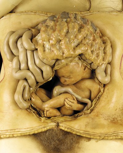 卵巣妊娠の解剖学的モデル、詳細（ワックス）（1126545-7も参照 作： European School
