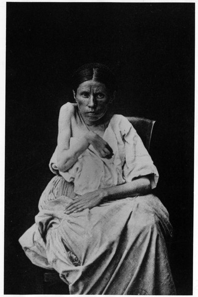 片麻痺のてんかん患者の写真（「サルペトリエールの写真図像」BournevilleとP.Regnard、パリ 作： French Photographer