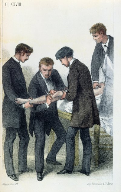 Jean-Baptiste-Leon Dubreuilによる医療マニュアルからの腕の切断、c.1850-60 作： French School