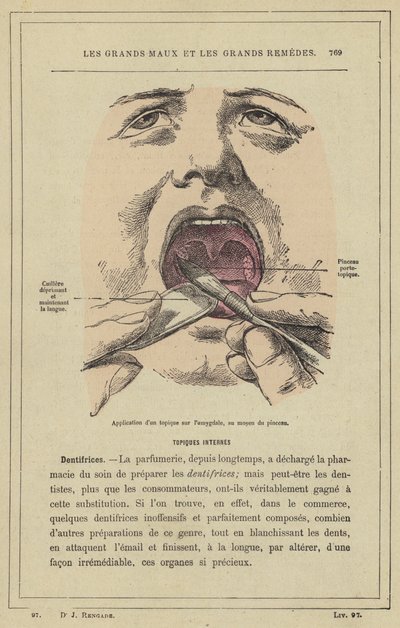 ブラシを使って扁桃腺に外用剤を塗布する（カラーリトグラフ 作： French School