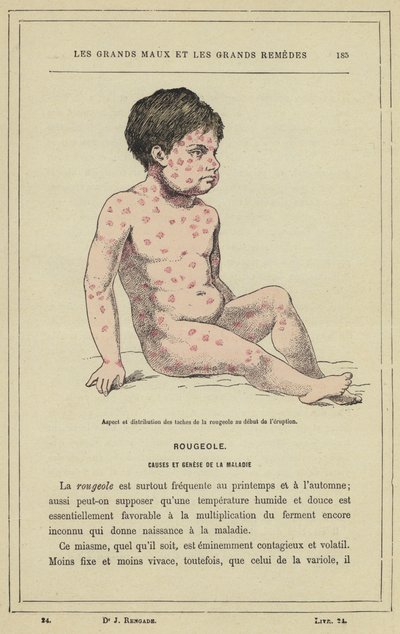 発疹の出始めの麻疹斑の出現と分布（カラーリトグラフ 作： French School