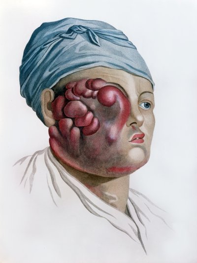 ジャン・ルイ・アリベール男爵（1768-1837）パリ、1806年のDescription des Maladies de la Peauからのガン性スクロフラ 作： French School